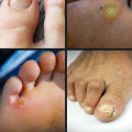 Expert's Guide to Common Foot Disorders